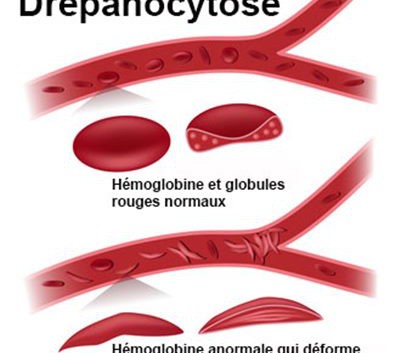 La drépanocytose…