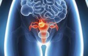 L’OMS lance une stratégie pour accélérer l’élimination du cancer du col de l’utérus L’OMS lance une stratégie pour accélérer l’élimination du cancer du col de l’utérus